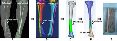 Influence of different fixation modes on biomechanical conduction of 3D printed prostheses for treating critical diaphyseal defects of lower limbs: A finite element study